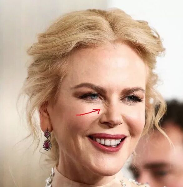 Alternativa a Botox